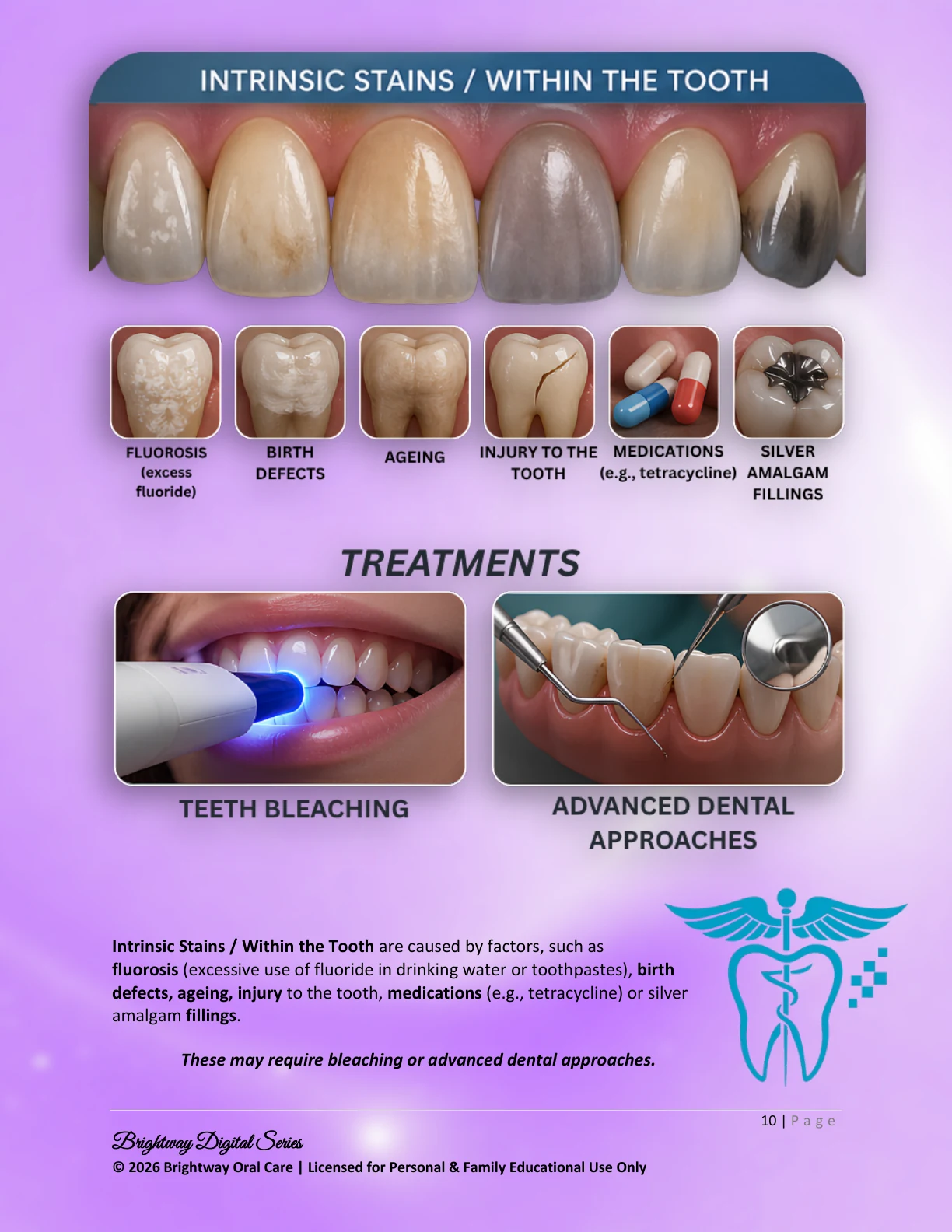 Intrinsic stains and treatment options preview