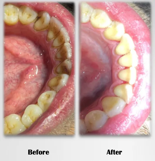 Before and after clinical photograph showing heavy tartar behind the lower front teeth removed by a deep cleaning