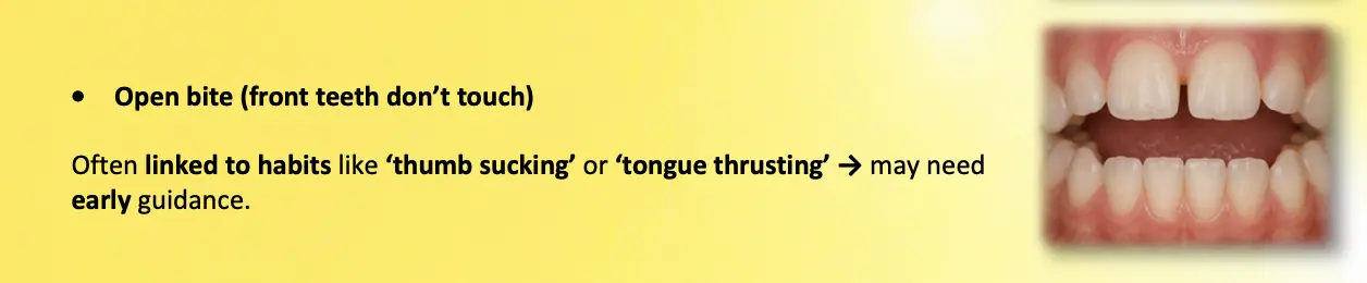 Illustration of an open bite from thumb sucking or tongue thrusting, where the front teeth do not meet