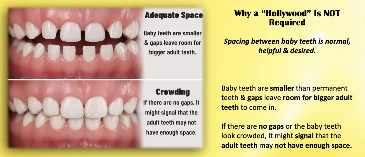 Illustration comparing normal spacing between baby teeth with crowded baby teeth